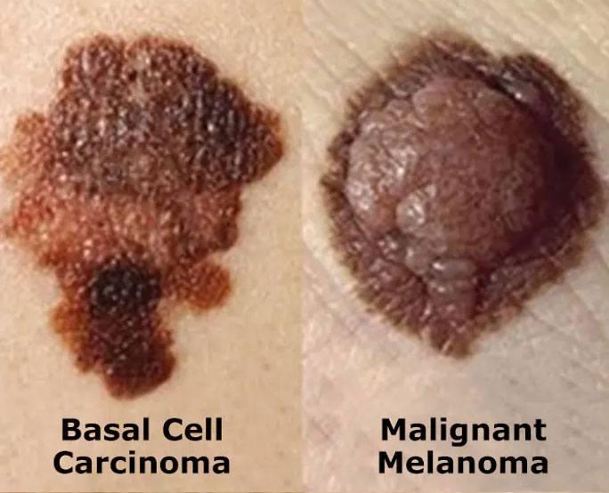 Skin cancer types showing basal cell carcinoma and malignant melanoma