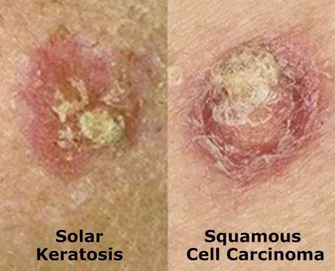 Skin cancer types showing solar keratosis and squamous cell carcinoma